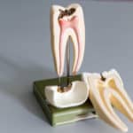 model of root canal