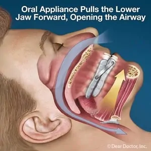 oral appliance diagram