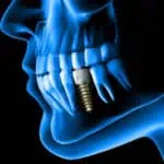 dental implant